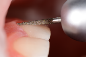 Cirurgia plástica periodontal para correção de sorriso gengival associada a laminados cerâmicos