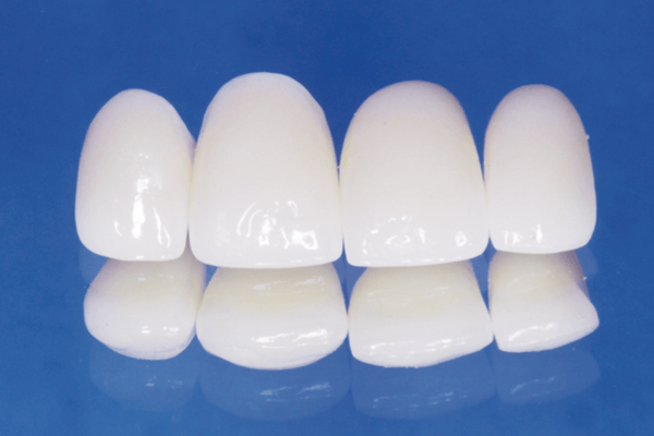 Correção estética do segmento maxilar anterior sobre implantes e dentes com abutments pré-fabricados e coroas em zircônia
