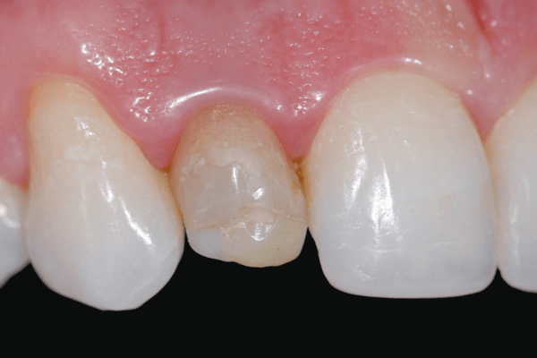 Tratamentos protéticos para dentes anteriores escurecidos