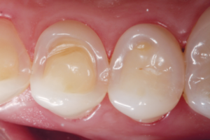 desgaste dental erosivo